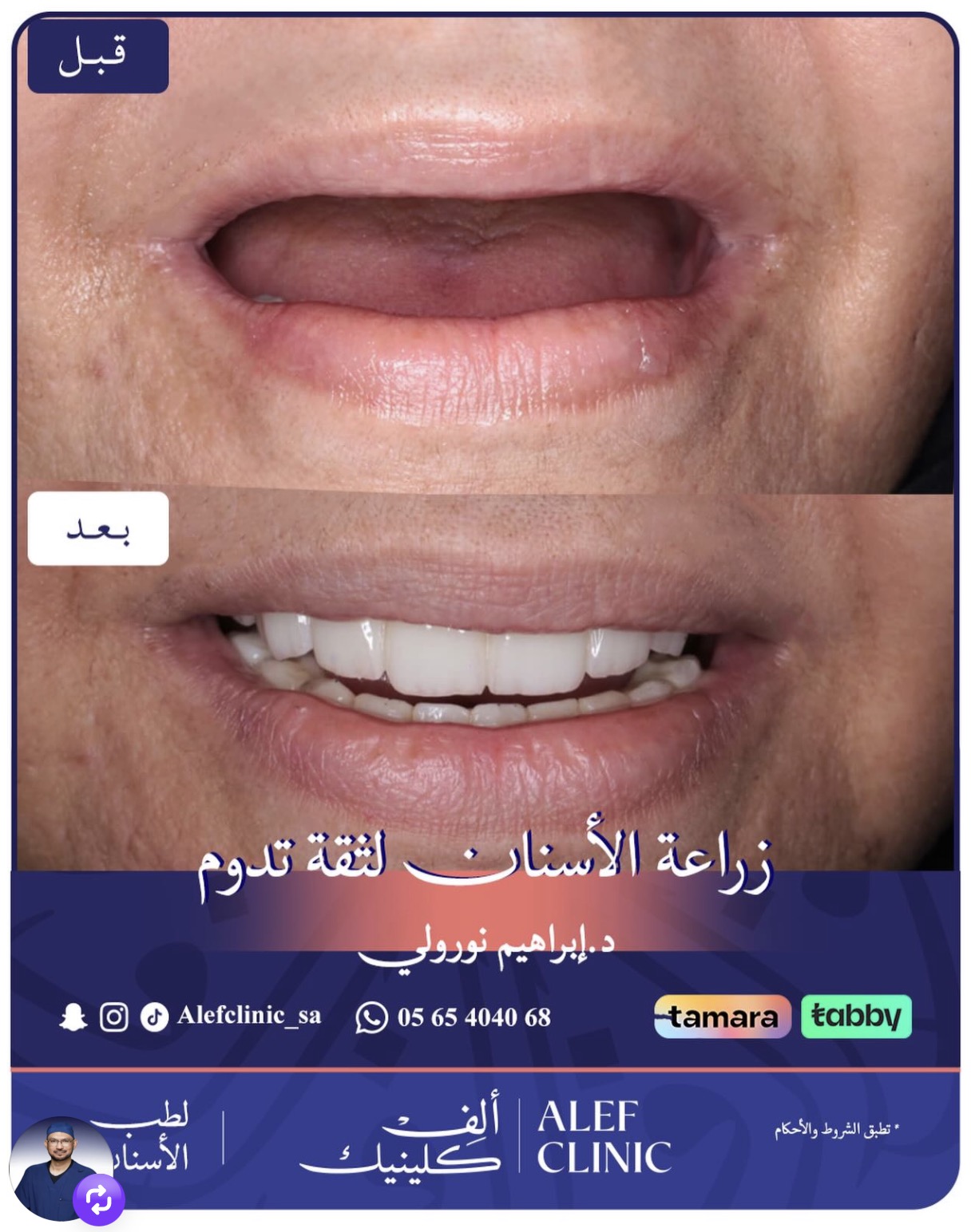 قبل وبعد